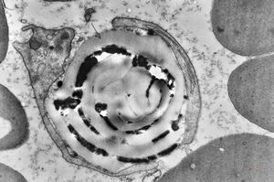 M,43y. | blood - degraded Candida (bone marrow suppression)